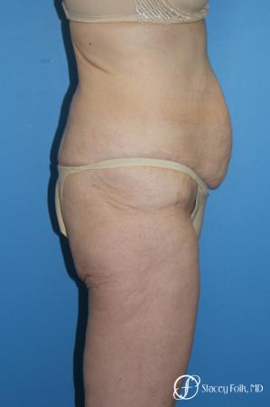 Denver Body Lift Belt lipectomy 5268 - Before and After Image 3