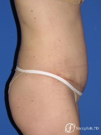 Denver Tummy Tuck - Abdominoplasty 10351 - After Image 3