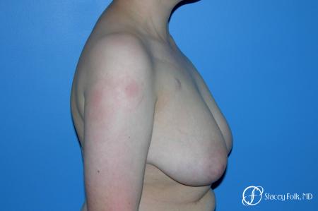 Denver Female to Male Top Surgery 5257 - Before Image 3