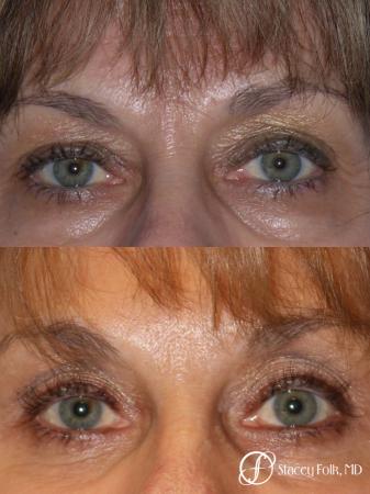 Denver Brow lift, Upper and Lower Lid Blepharoplasty 7162 - Before Image 1
