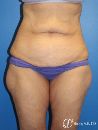 Denver Body Lift 10301 - Before Image 1