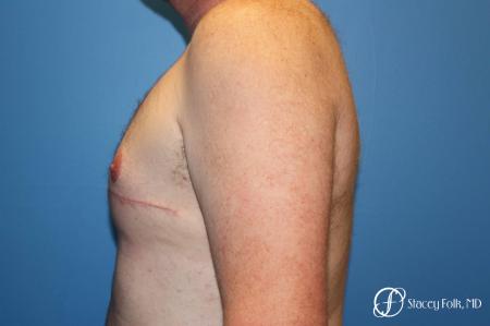 Denver FTM Female to Male Top Surgery 7109 - After Image 3