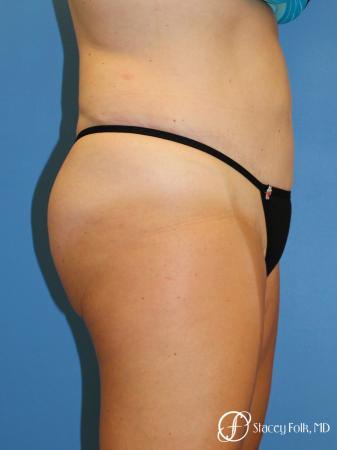 Denver Tummy Tuck - Abdominoplasty 7714 - After Image 3