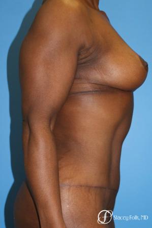 Denver Breast Lift - Mastopexy, and Tummy Tuck - Abdominoplasty 7512 - After Image 4