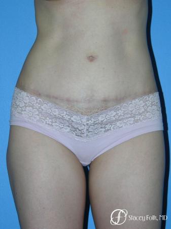 Denver Tummy Tuck - Abdominoplasty 10444 - After Image 1