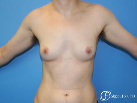 Denver FTM Female to male top surgery 6608 - Before Image 1