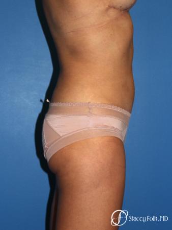Liposuction - After Image 1