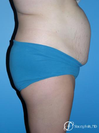Denver Tummy Tuck - Abdominoplasty 7714 - Before and After Image 3