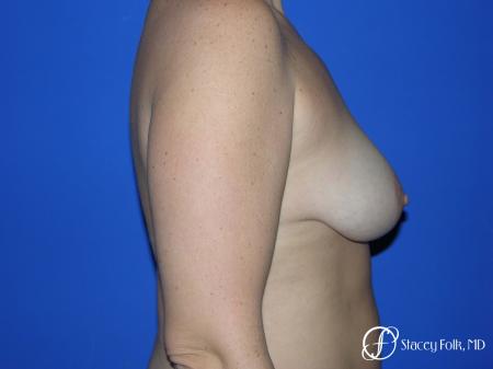 Denver Breast Lift - Mastopexy Augmentation 7989 - Before and After Image 3