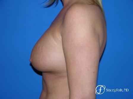 Denver Breast Augmentation 31 - After Image 3