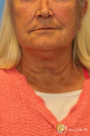 Facelift and Laser - Before and After Image 2