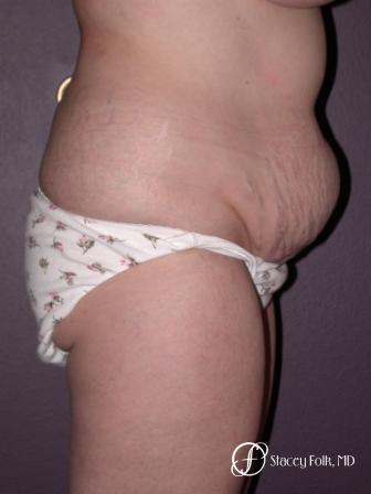 Denver Tummy Tuck 18 - Before and After 2