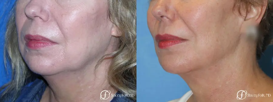 Denver Facial Rejuvenation Facelift, Fat Transfer, and Laser Resurfacing 8513 - Before and After 2