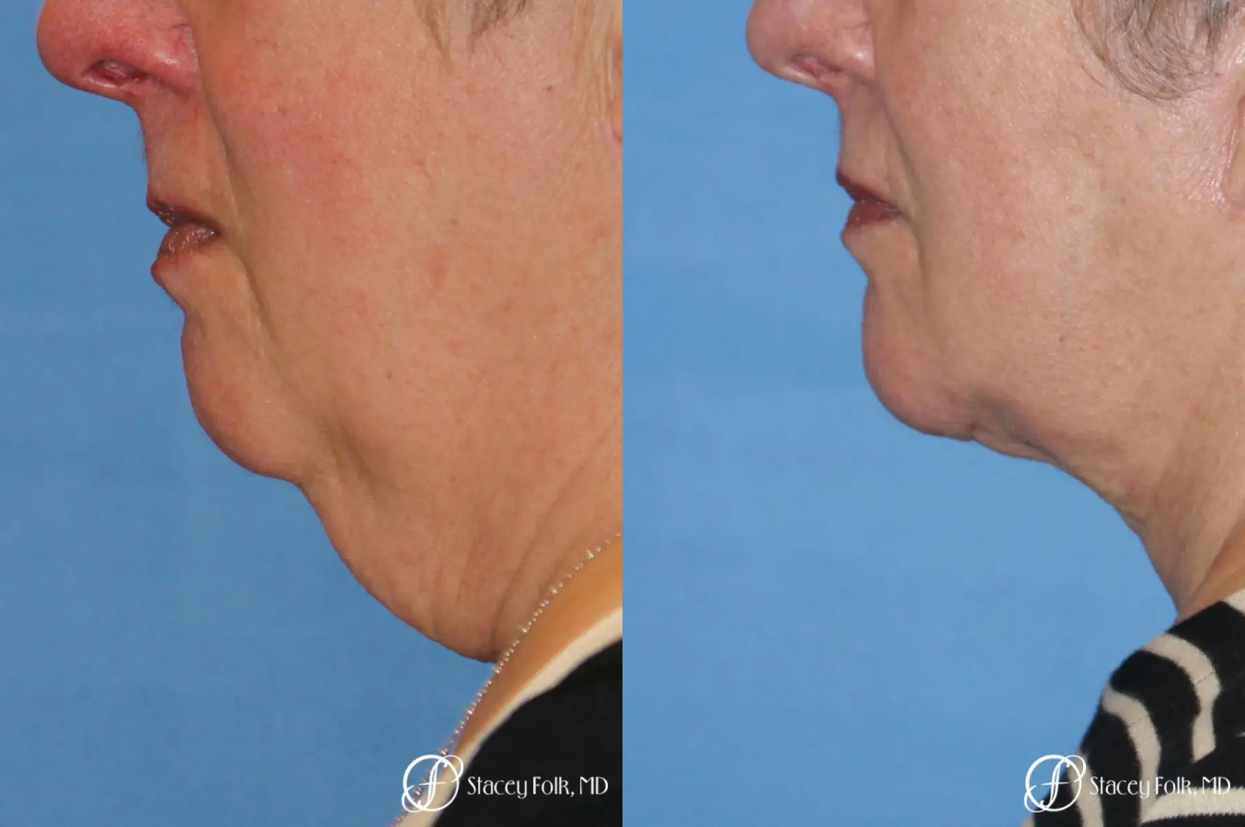 Denver Facial Rejuvenation Face and Neck Lift with Fat Transfer to the Face 9133 - Before and After 1