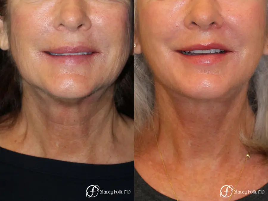 Denver Facelift & Laser Resurfacing 8277 - Before and After 3