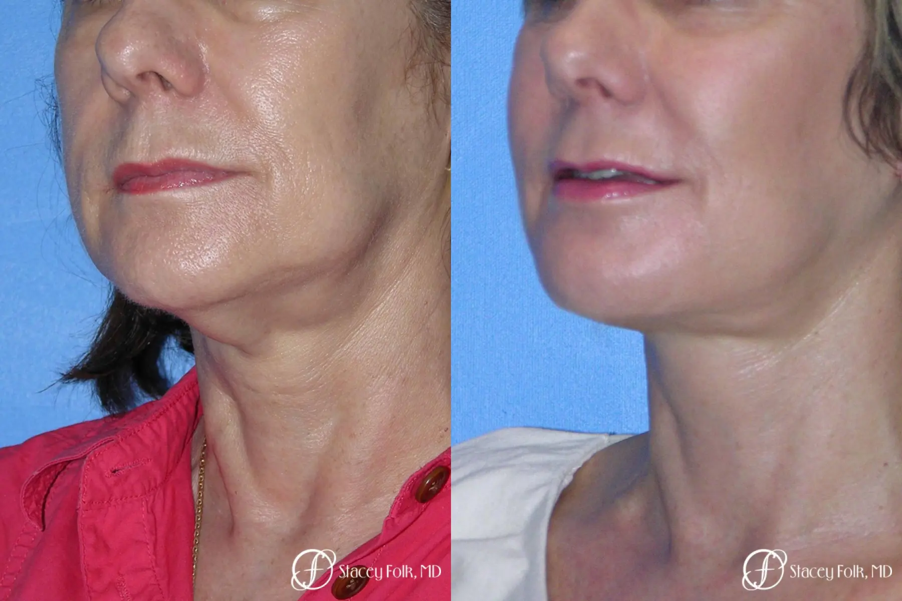 Denver Facial Rejuvenation Face Lift and Fat Injections 7117 - Before and After 2