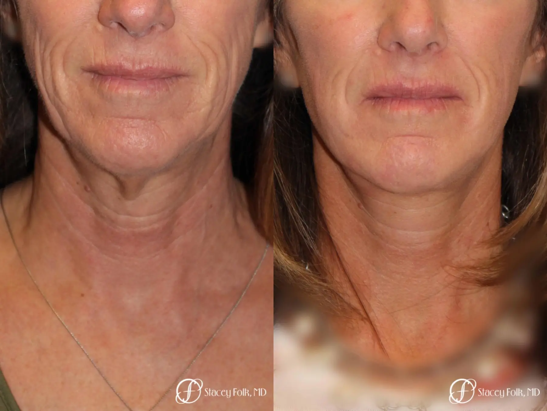 Denver Facial Rejuvenation Face lift, Fat Injections, and Laser Resurfacing 7132 - Before and After 3