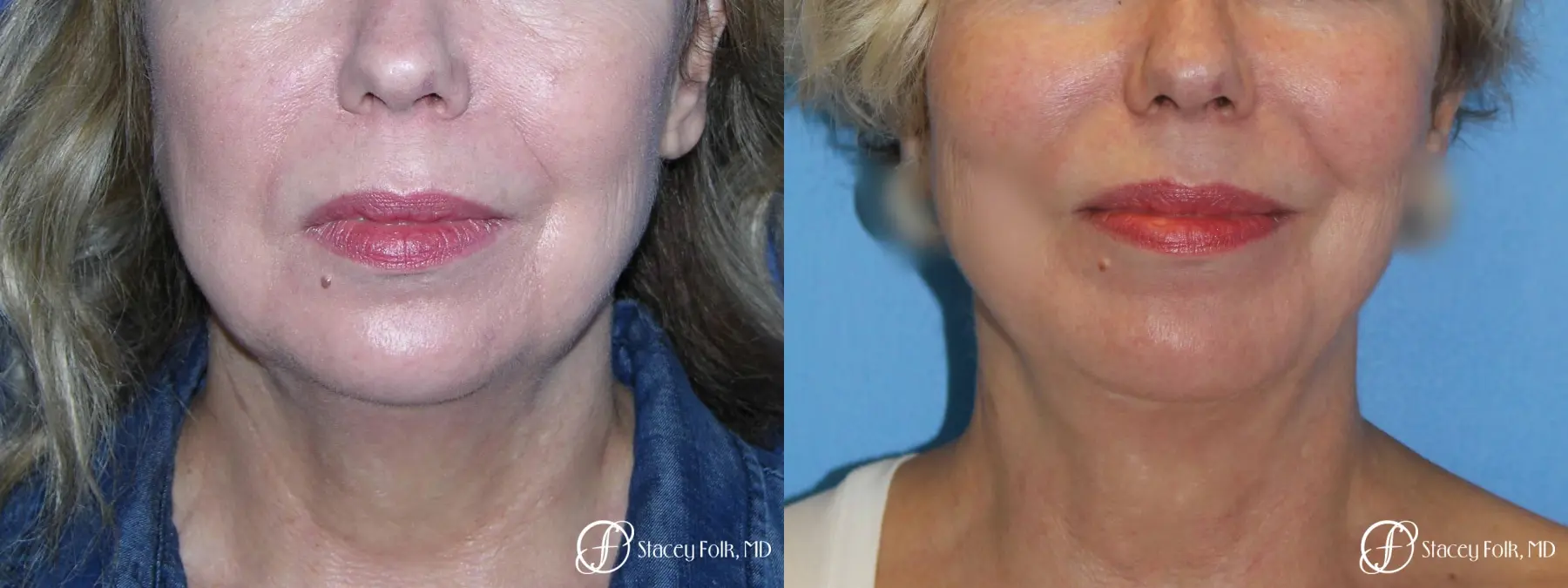Denver Facial Rejuvenation Facelift, Fat Transfer, and Laser Resurfacing 8513 - Before and After 3