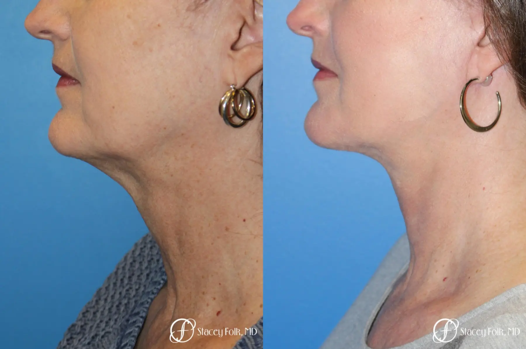 Denver Facial Rejuvenation Facelift, Blepharoplasty, Fat Transfer, Laser Resurfacing 10350 - Before and After 1