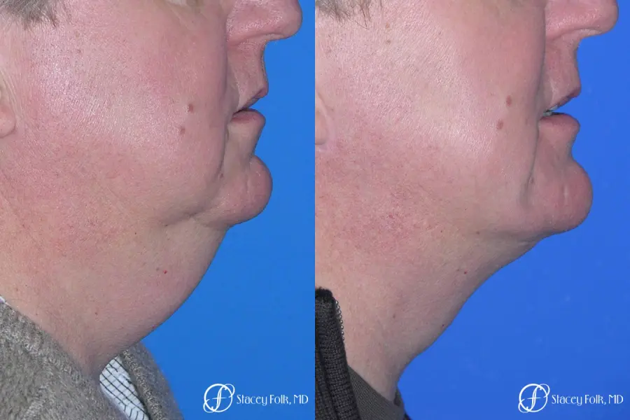 Denver Facial Rejuvenation Face lift, and Fat injections 7157 - Before and After 2