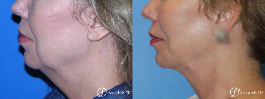 Denver Facial Rejuvenation Facelift, Fat Transfer, and Laser Resurfacing 8513 - Before and After 1