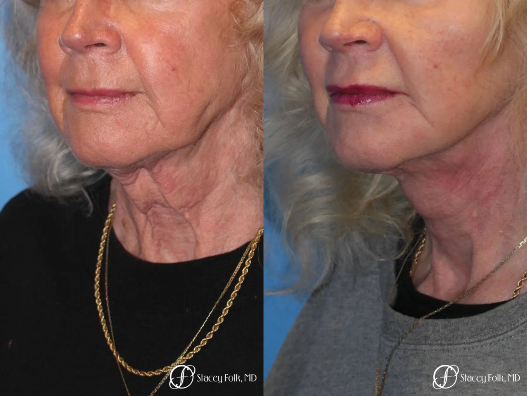 Denver Facial Rejuvenation Face lift, Fat Injections, and Laser Resurfacing 7131 - Before and After 2