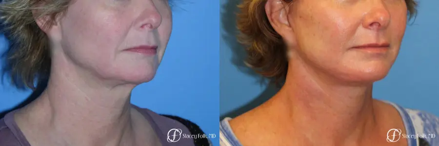 Denver Facial Rejuvenation Face Lift 7121 - Before and After 4