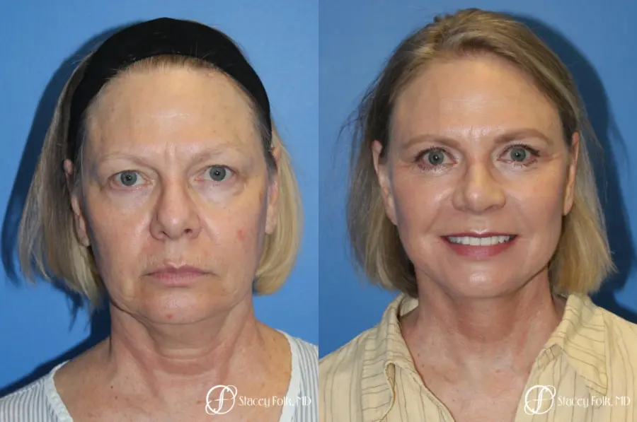 Facial Rejuvenation: Patient 1 - Before and After 1