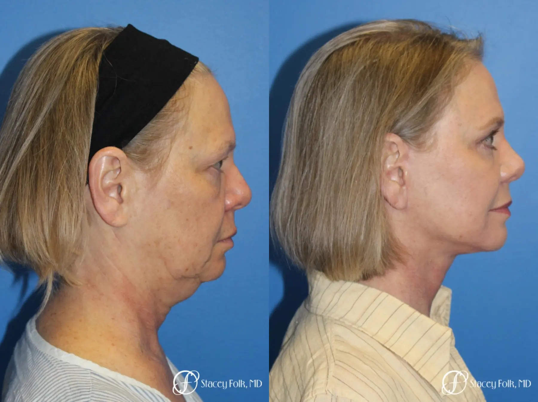 Facial Rejuvenation: Patient 1 - Before and After 3