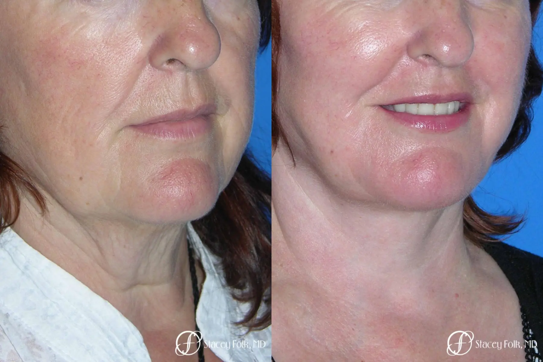 Denver Facial Rejuvenation Face lift, Fat Injections, Laser Resurfacing 7133 - Before and After 2
