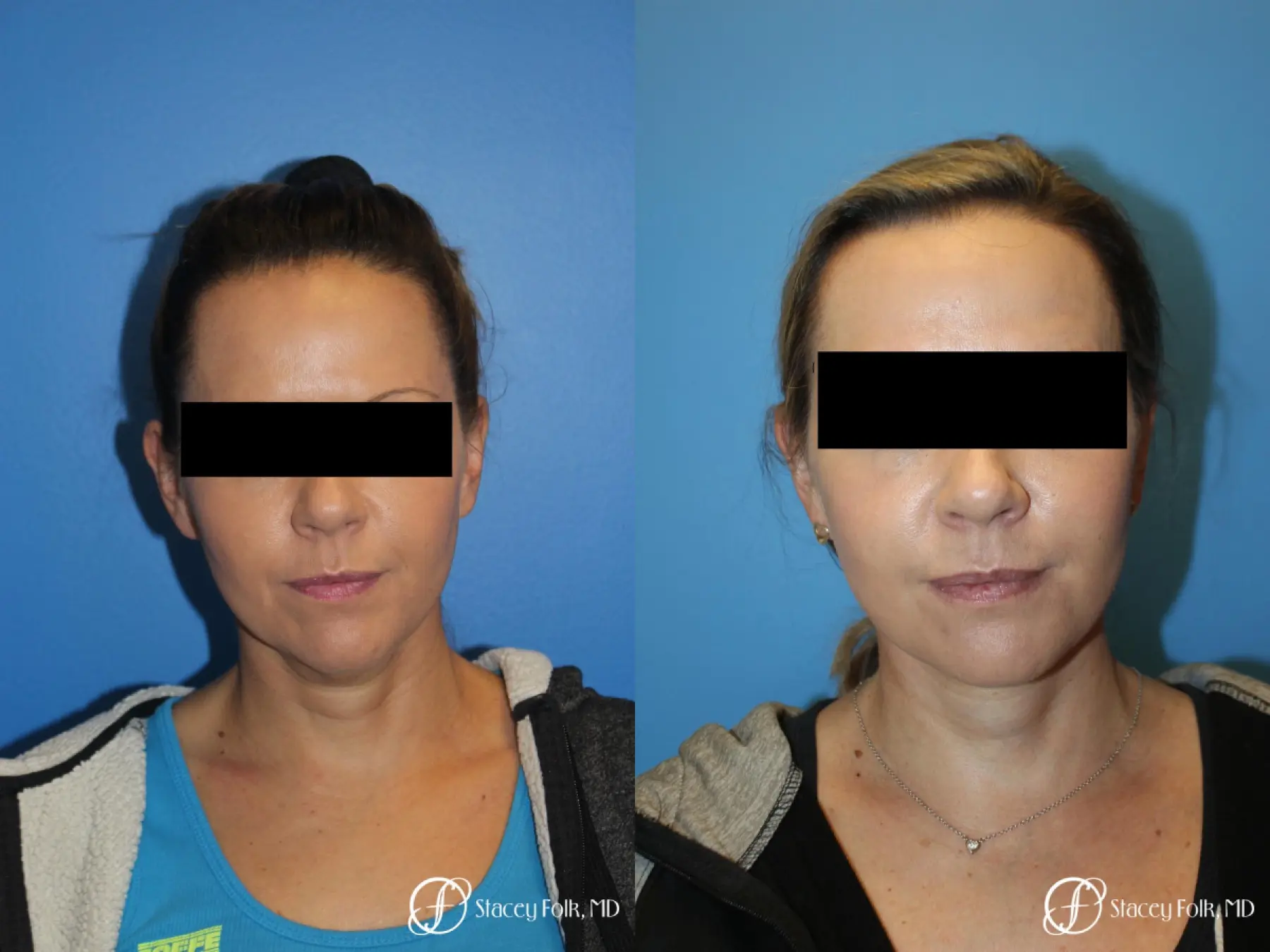 Facial Rejuvenation: Patient 24 - Before and After  