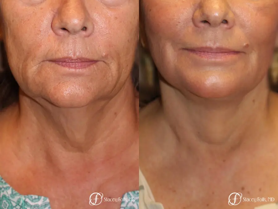 Denver Facial Rejuvenation Face Lift, Fat Injection, Laser Resurfacing 7123 - Before and After 3