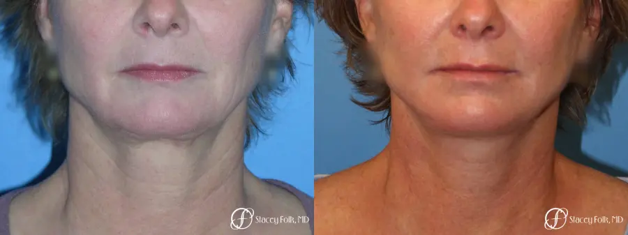 Denver Facial Rejuvenation Face Lift 7121 - Before and After 3