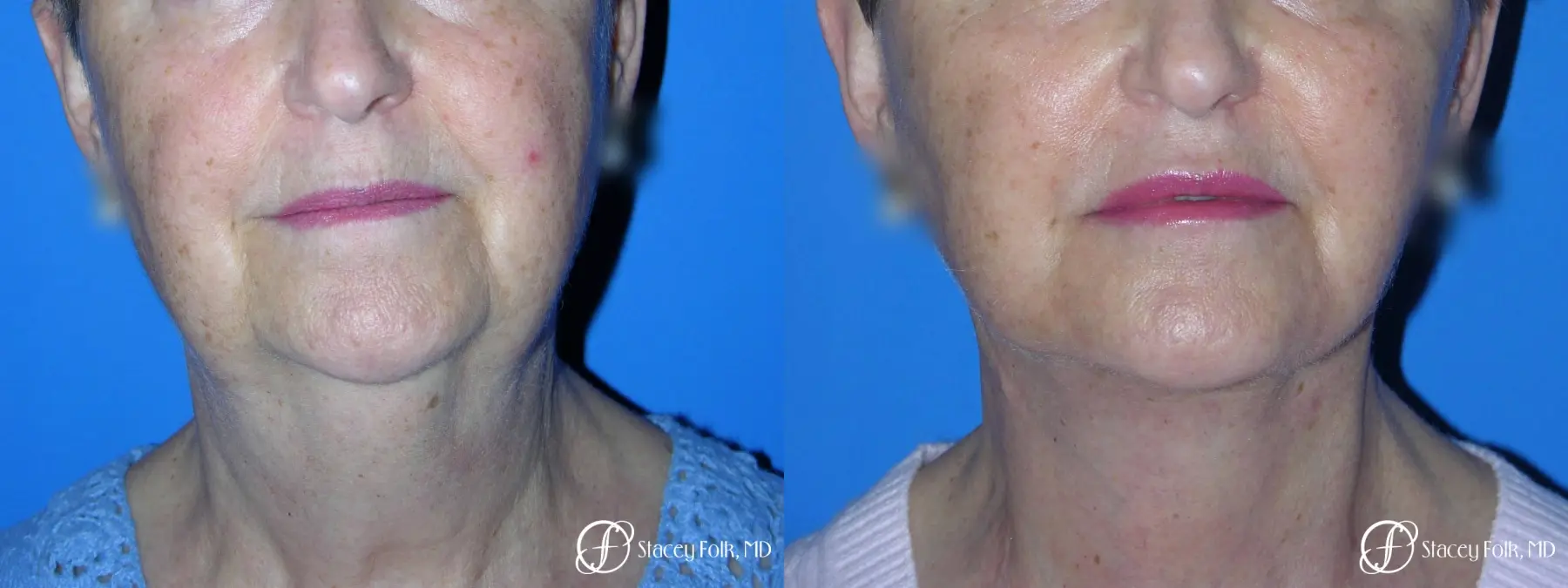 Denver Facial Rejuvenation Face Lift and Fat Injections 7130 - Before and After 2