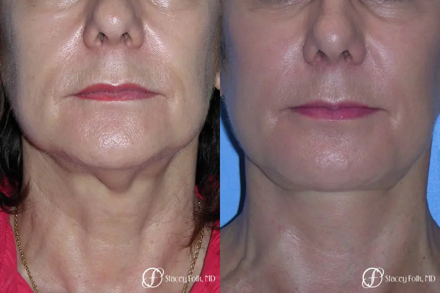 Denver Facial Rejuvenation Face Lift and Fat Injections 7117 - Before and After 3