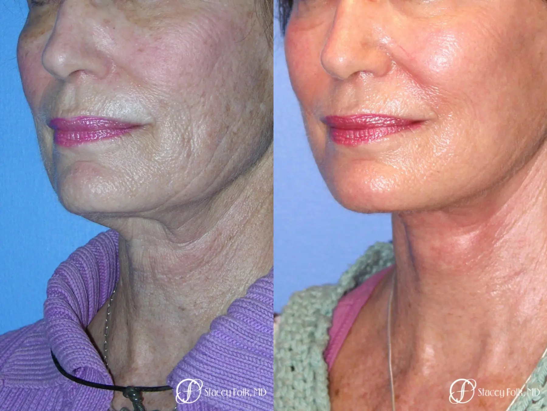 Denver Facial Rejuvenation Face Lift, Fat Injections, Laser Resurfacing 7116 - Before and After 2