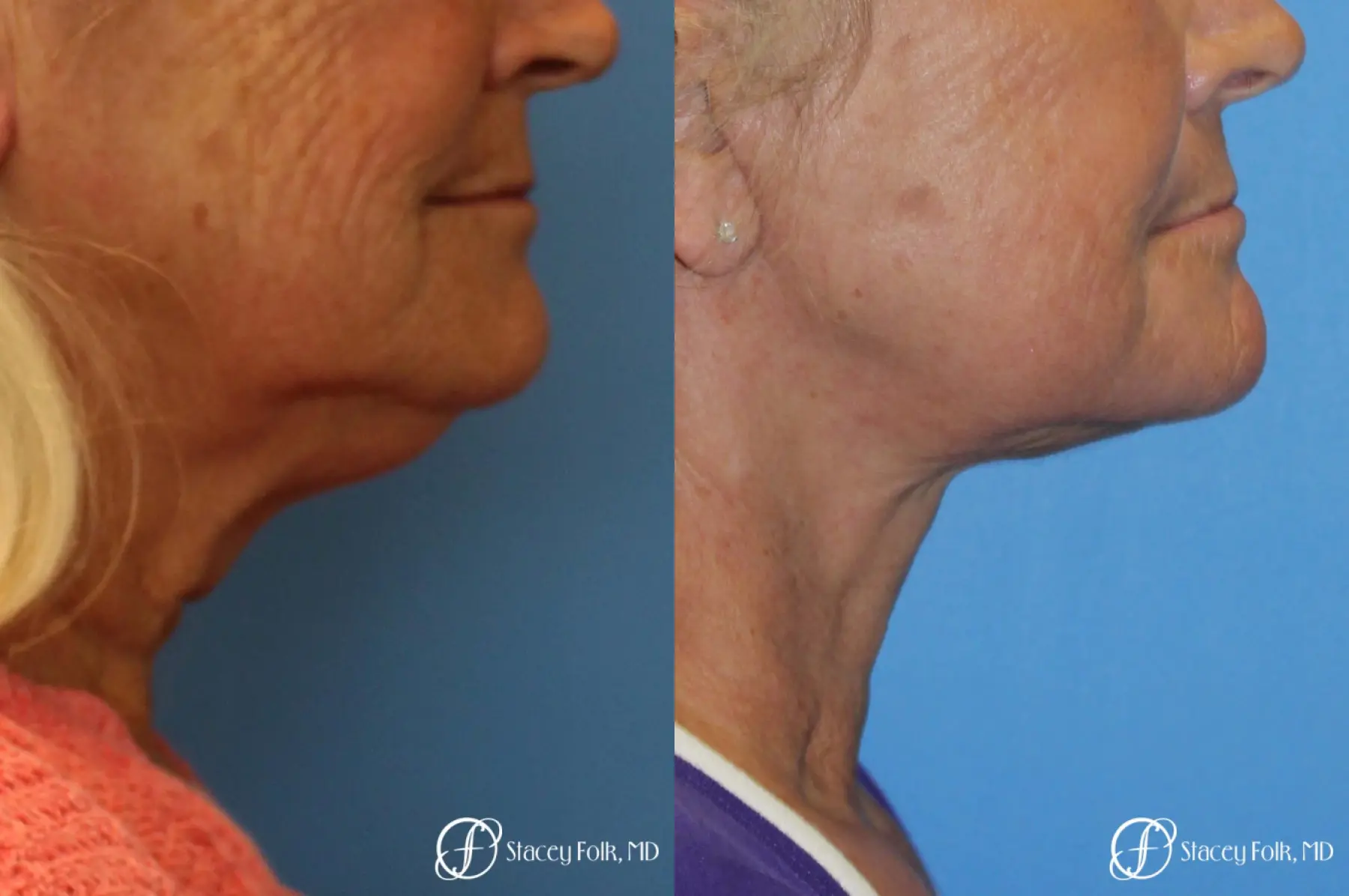 Facelift and Laser - Before and After