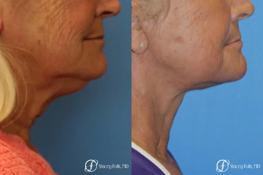 Facelift and Laser - Before and After 1