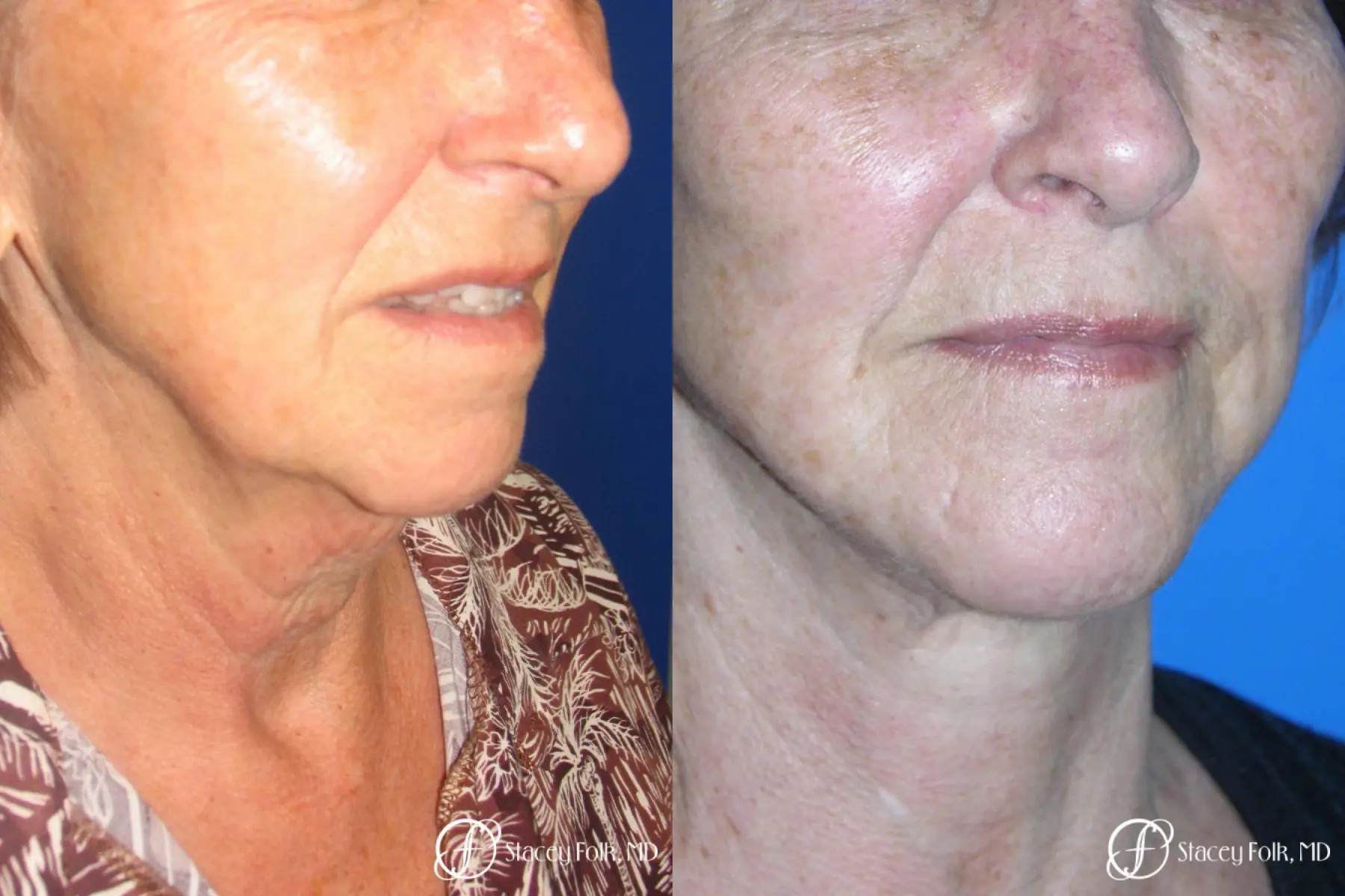 Denver Facial Rejuvenation Face Lift and Fat Injections 7129 - Before and After 2