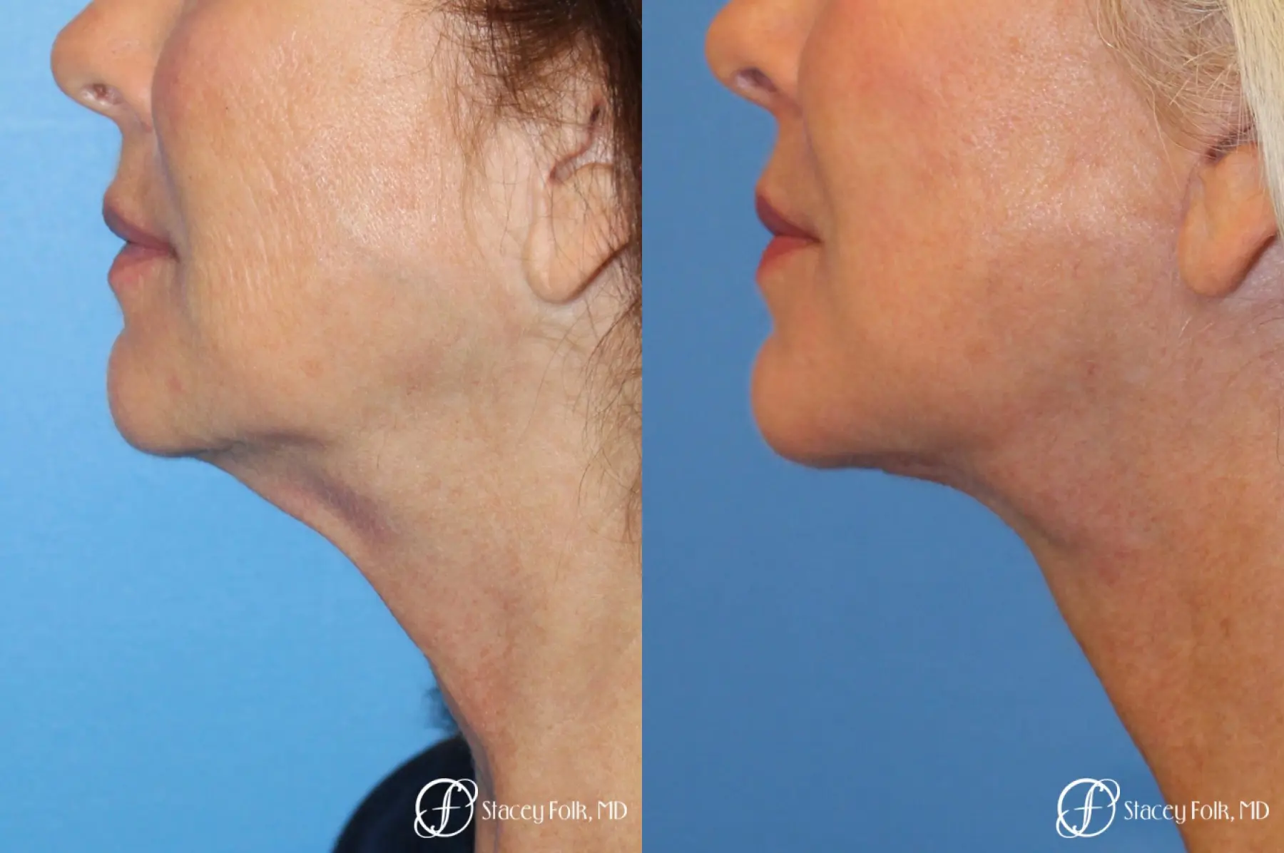 Denver Facelift & Laser Resurfacing 8277 - Before and After