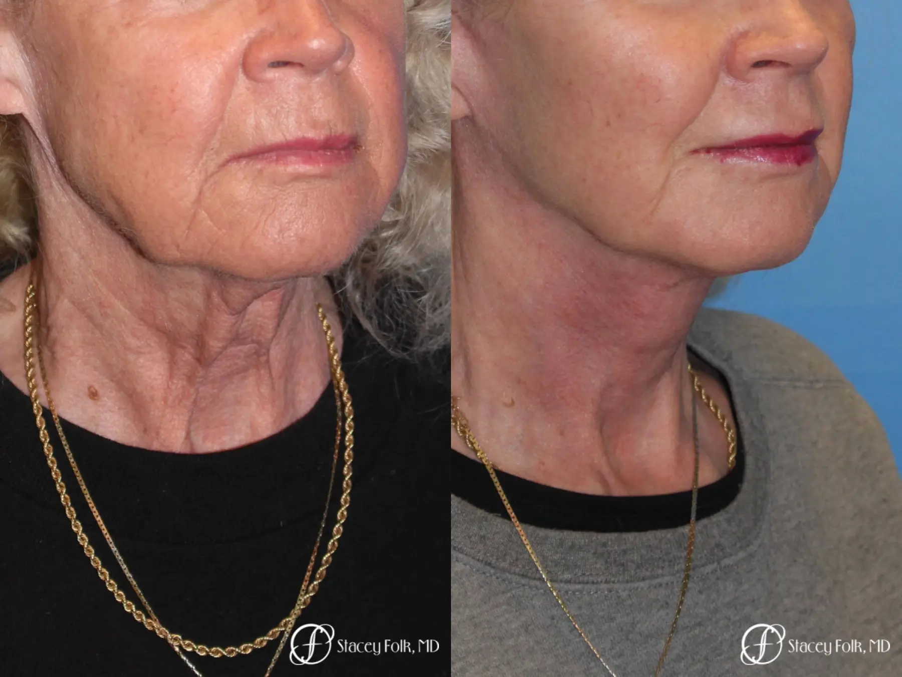 Denver Facial Rejuvenation Face lift, Fat Injections, and Laser Resurfacing 7131 - Before and After 4