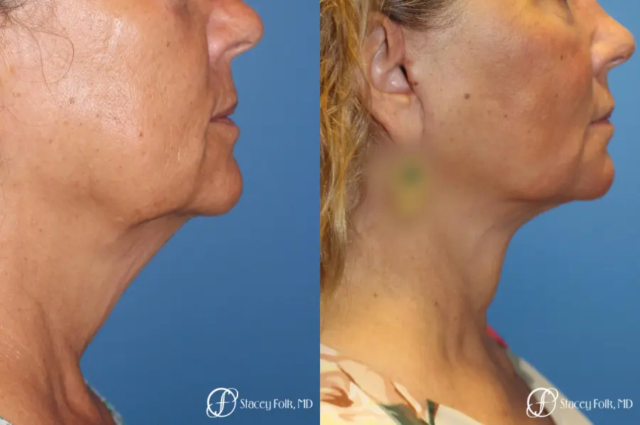 Denver Facial Rejuvenation Face Lift, Fat Injection, Laser Resurfacing 7123 - Before and After 1