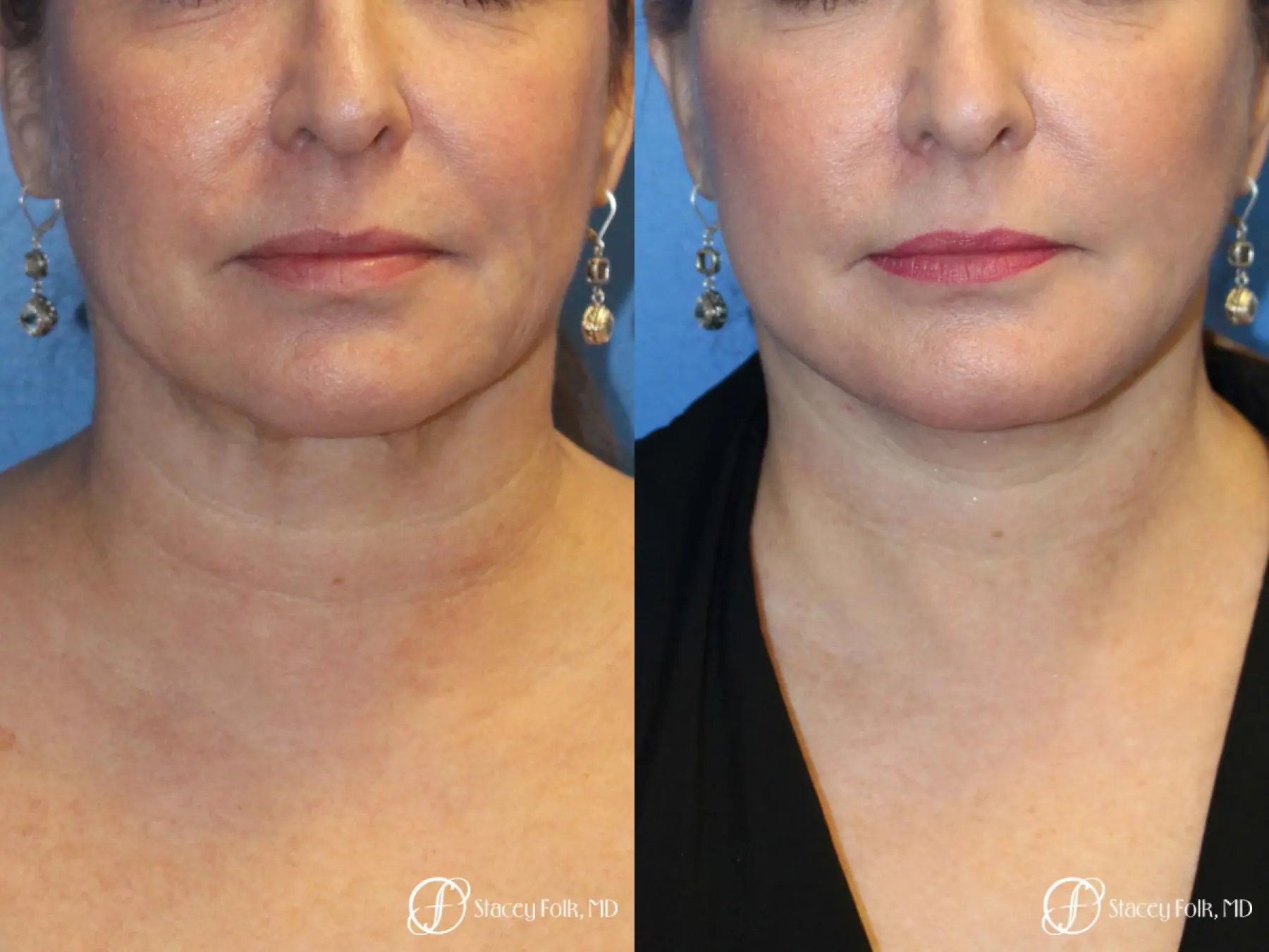 Denver Facial Rejuvenation 9894 - Before and After 2