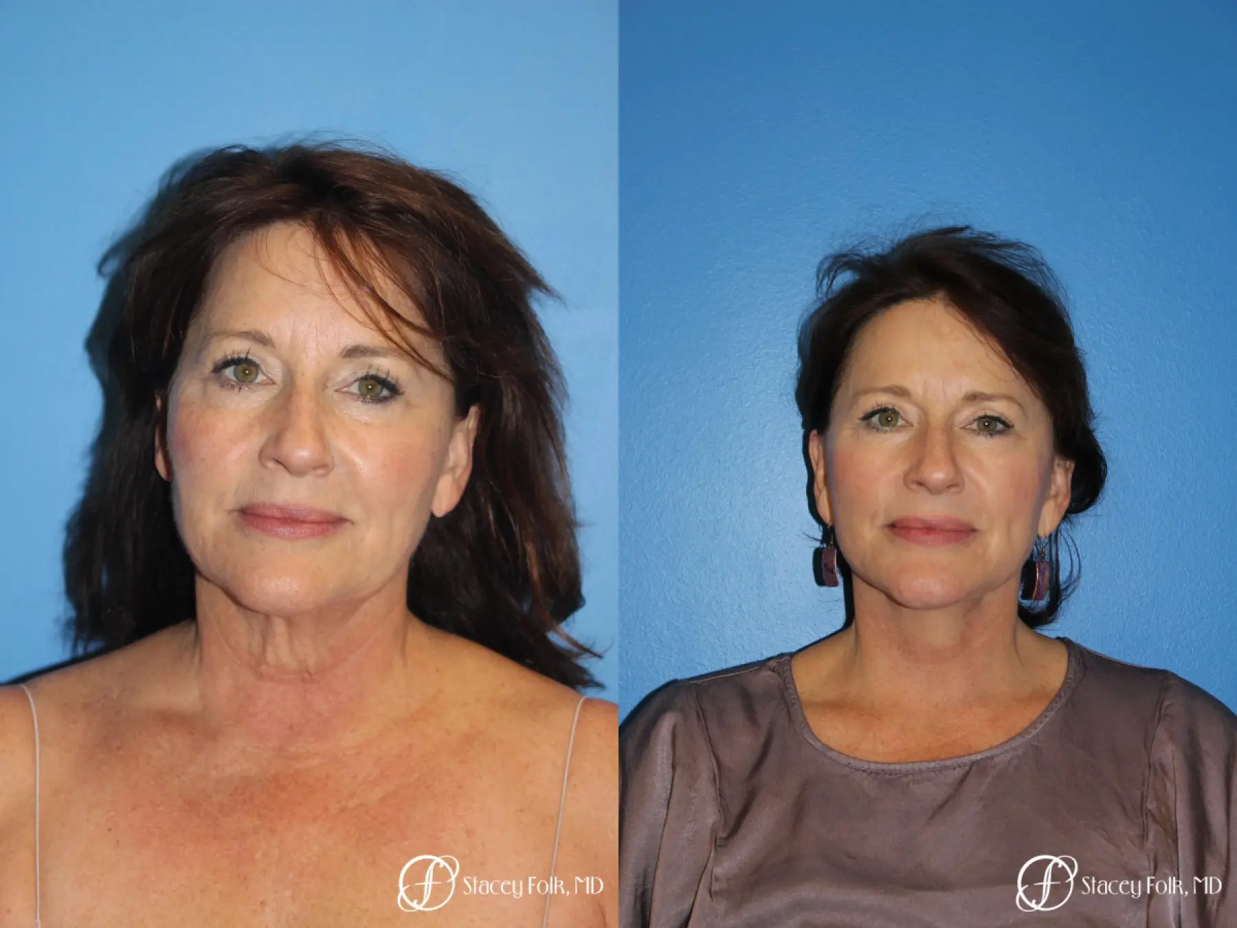 Facial Rejuvenation: Patient 25 - Before and After  
