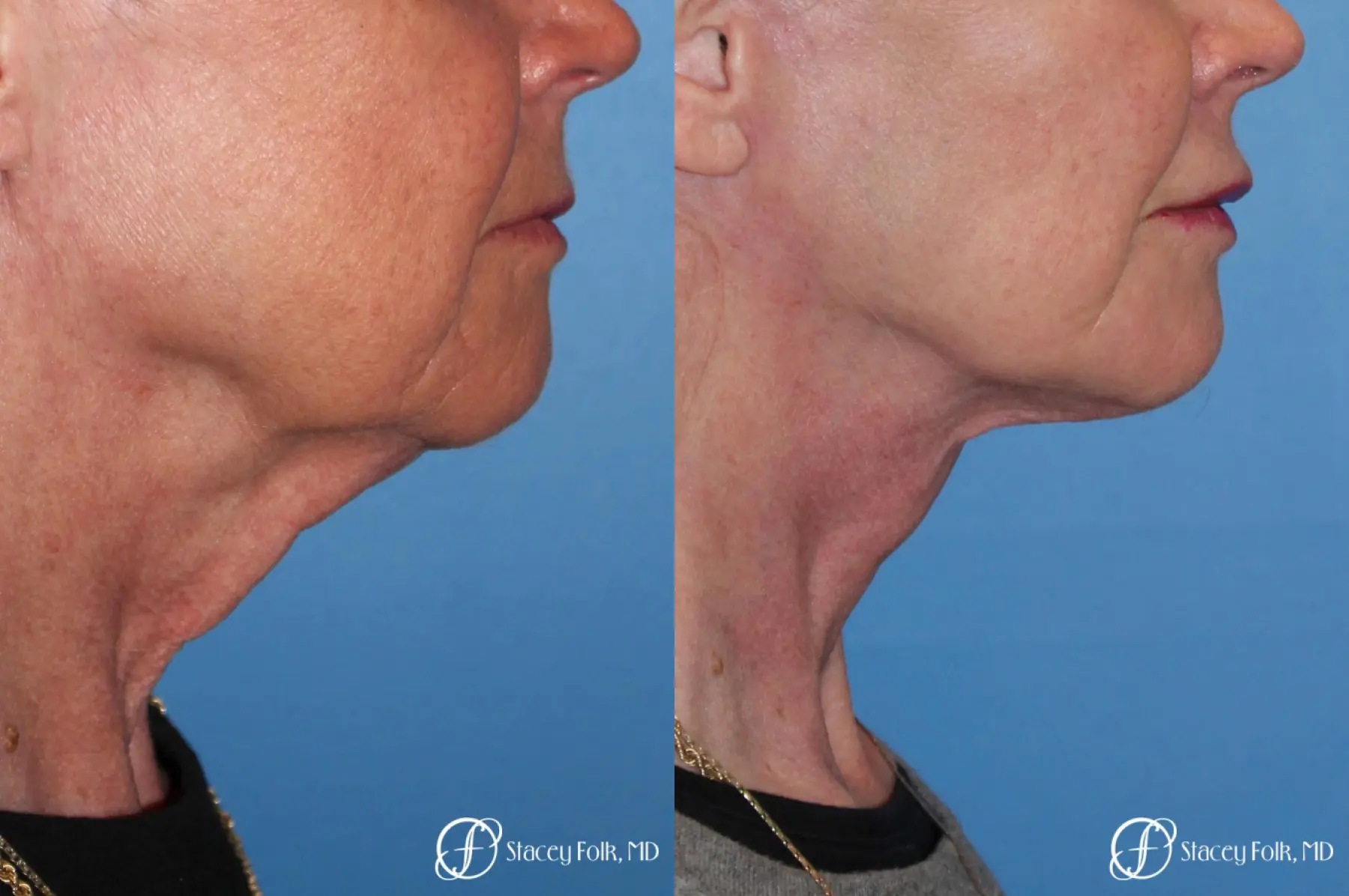 Denver Facial Rejuvenation Face lift, Fat Injections, and Laser Resurfacing 7131 - Before and After 1