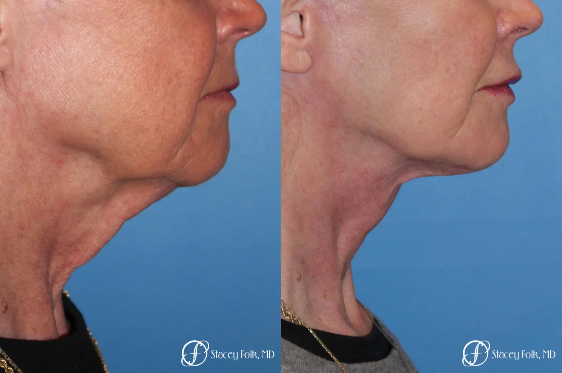 Denver Facial Rejuvenation Face lift, Fat Injections, and Laser Resurfacing 7131 - Before and After