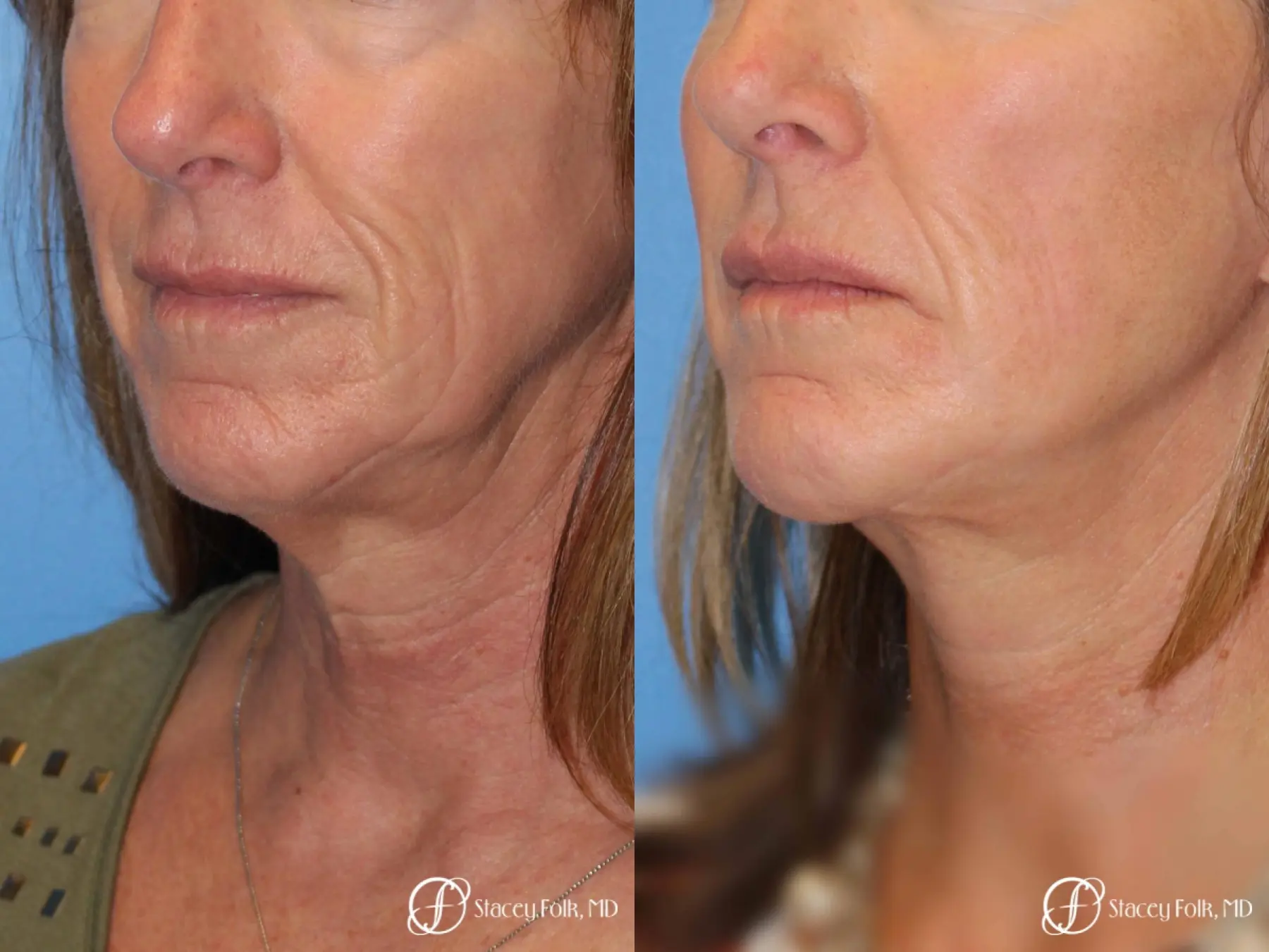 Denver Facial Rejuvenation Face lift, Fat Injections, and Laser Resurfacing 7132 - Before and After 2