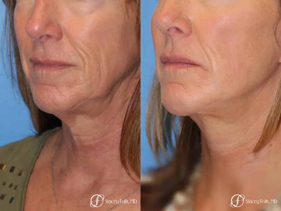Denver Facial Rejuvenation Face lift, Fat Injections, and Laser Resurfacing 7132 - Before and After 2