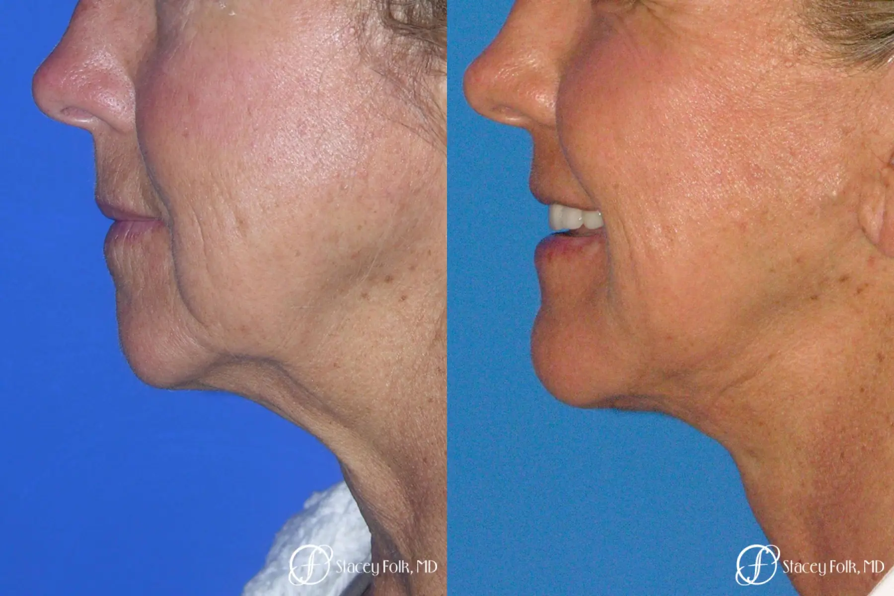 Denver Facial Rejuvenation Face Lift and Laser Resurfacing 7119 - Before and After 1