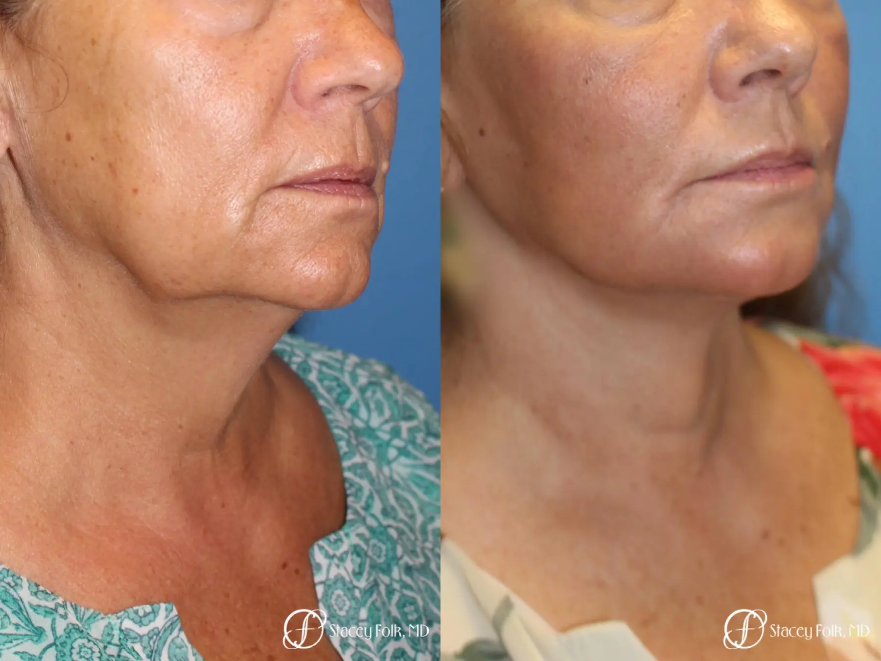 Denver Facial Rejuvenation Face Lift, Fat Injection, Laser Resurfacing 7123 - Before and After 2